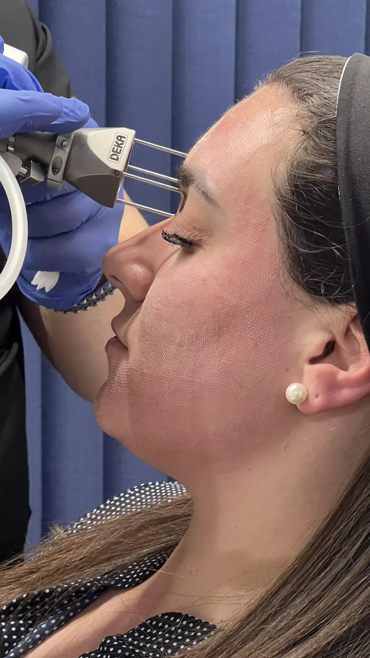 Εφαρμογή fractional laser στο πρόσωπο κατά τη διάρκεια συνεδρίας