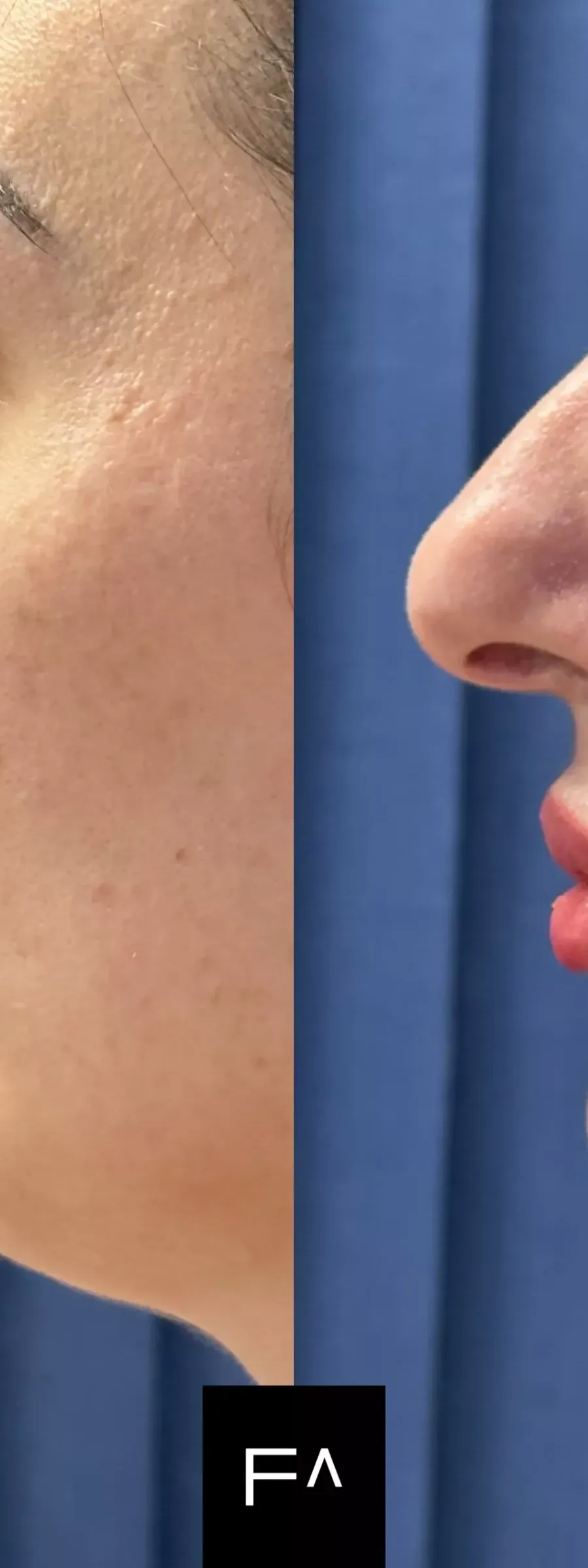 Hyaluronic Acid – Before and after results of Hyaluronic Acid implantation in the nose and lips, side view.