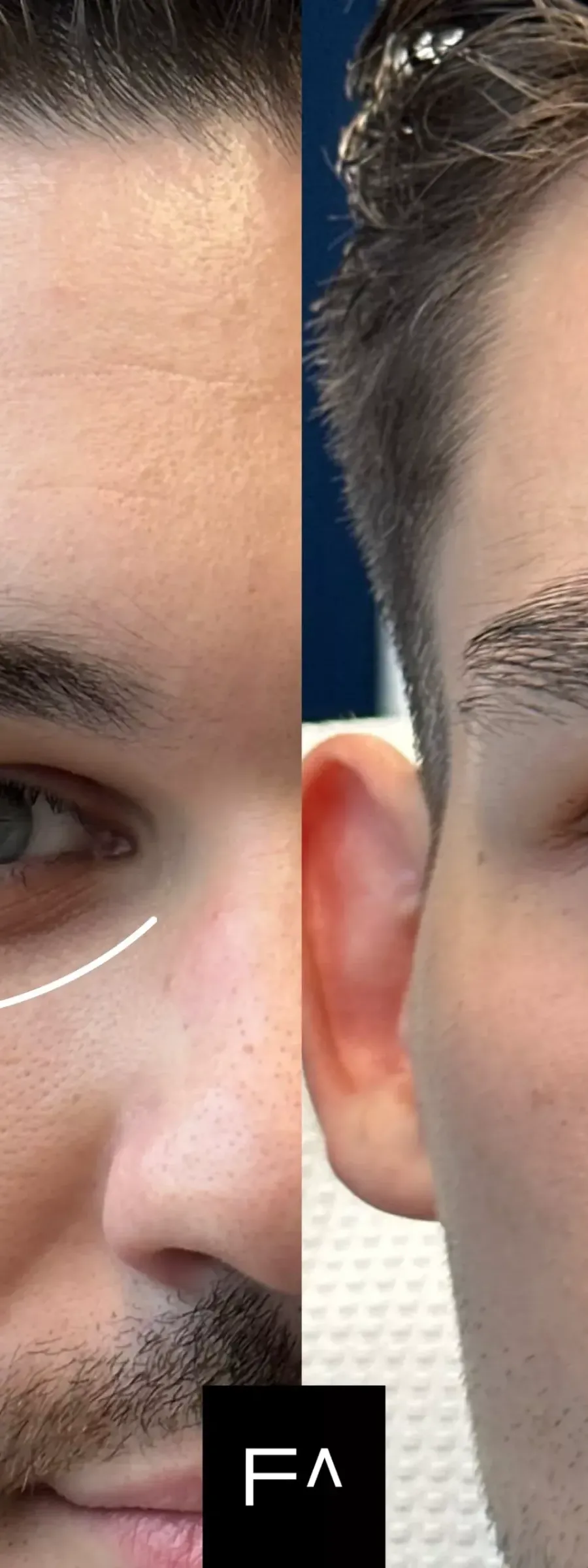 Αποτελέσματα Botox: Άνδρας πριν και μετά τη θεραπεία για ρυτίδες έκφρασης και πόδι χήνας.
