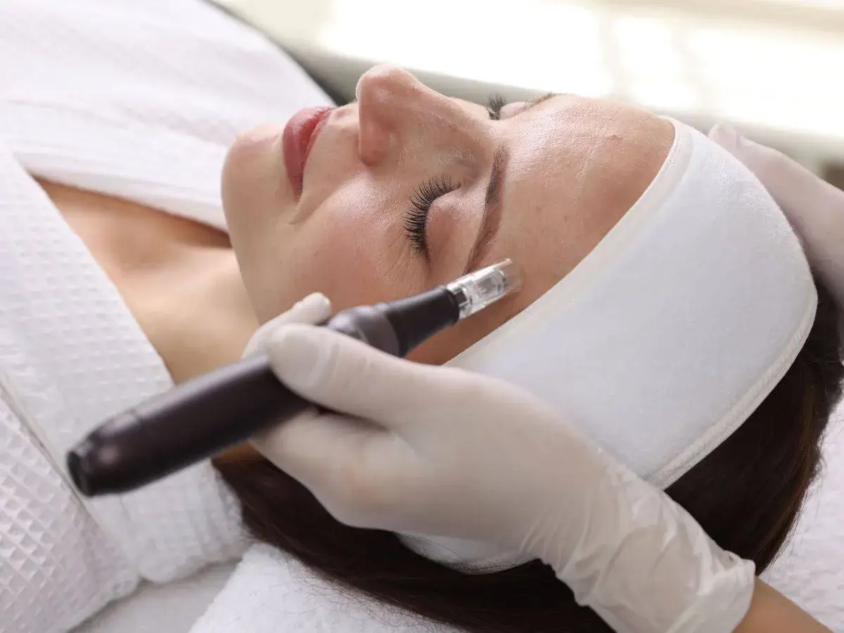 microneedling στο πρόσωπο γυναίκας για ανανέωση επιδερμίδας.