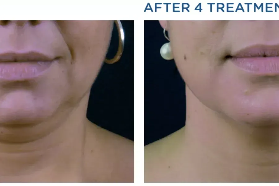 πριν και μετά Notox Exilis στο διπλοσάγονο και το περίγραμμα του προσώπου