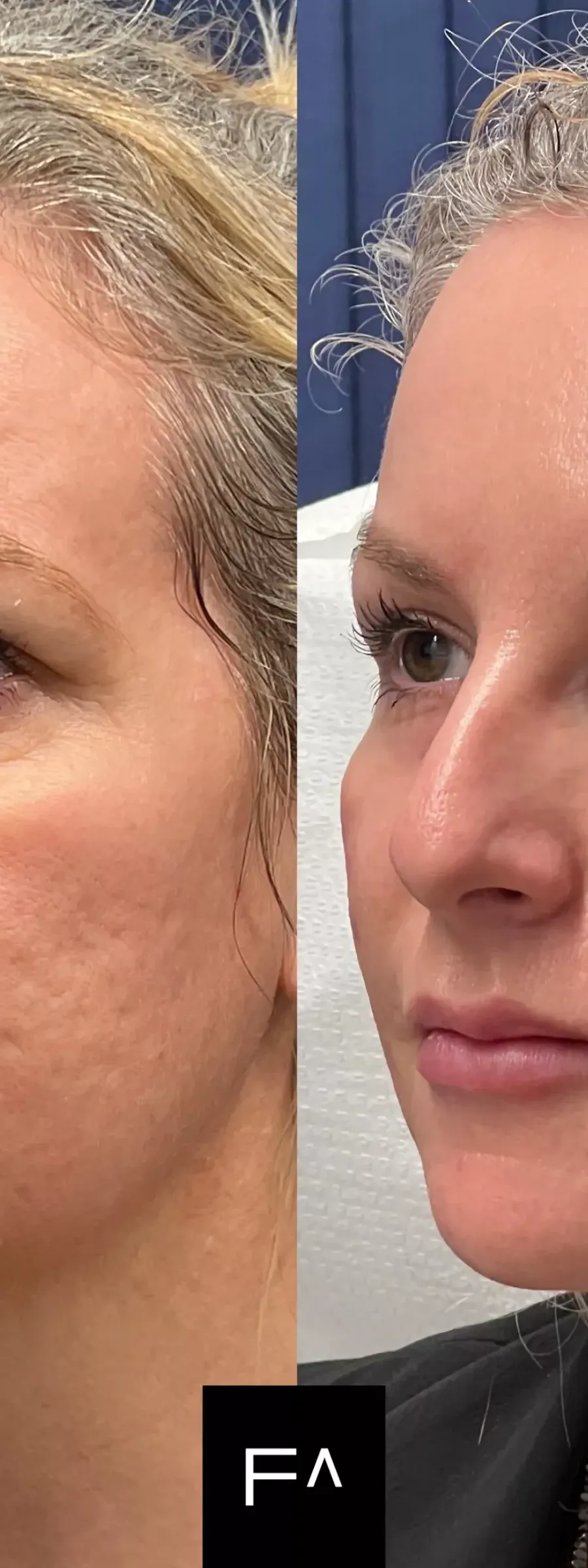 before and after Beautification: What it is, Procedure & Facial Results in the side profile
