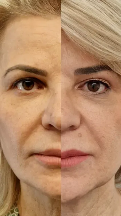 Βλεφαροπλαστική πριν και μετά, πρόσωπο γυναίκας με ανανεωμένο βλέμμα μετά την επέμβαση.