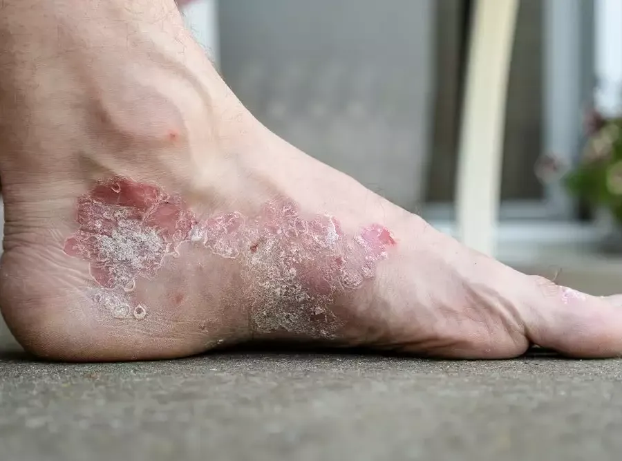 Psoriasis: Early Stage, Pictures, Symptoms, and Treatment: red, scaly patches on an adult's foot.