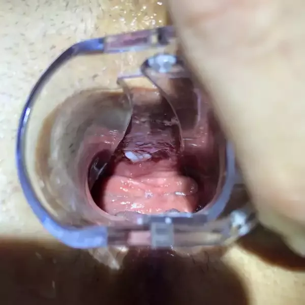 εσωτερικά κονδυλώματα στον κόλπο με διαστολέα, μεγεθυμένη όψη κονδυλώματα