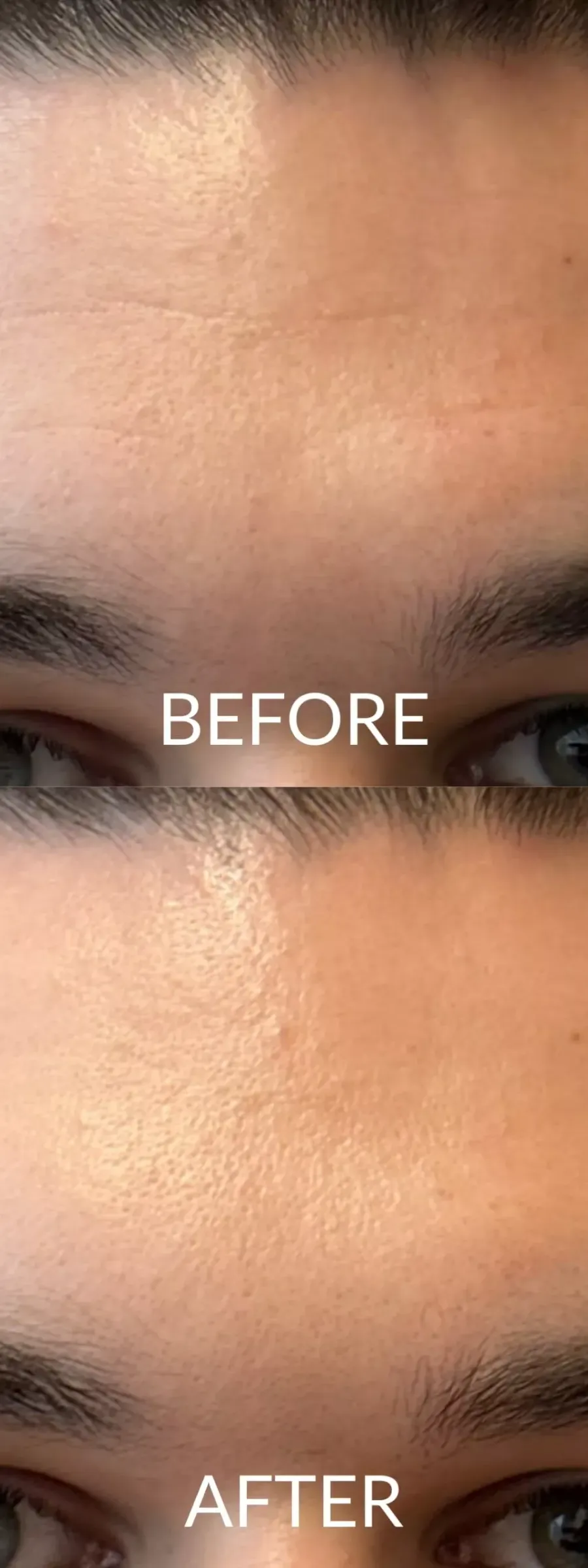 Αποτελέσματα Botox στην εξομάλυνση των γραμμών στο μέτωπο, πριν και μετά.