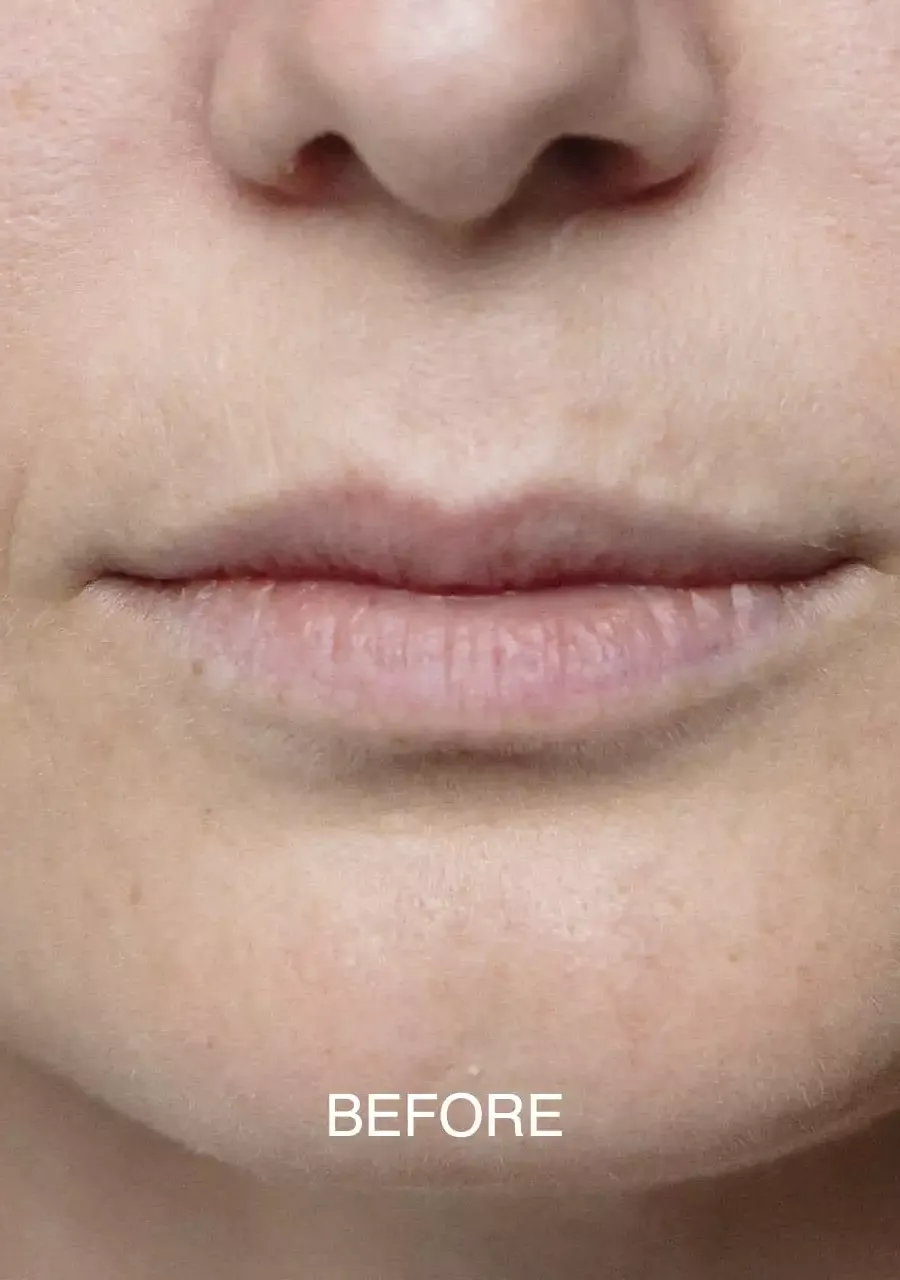 Lips — before