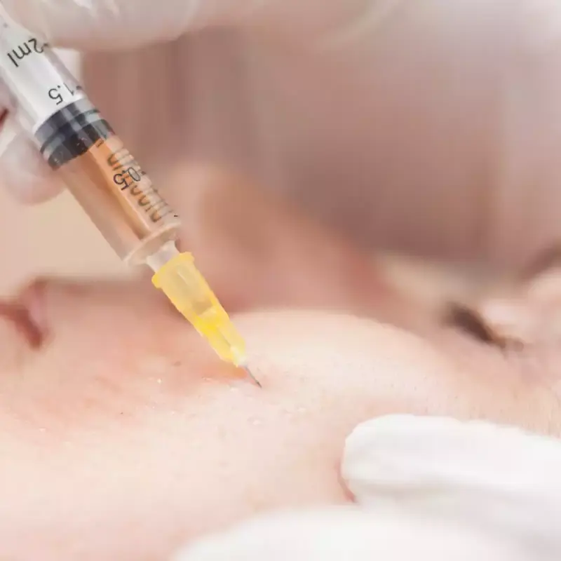 PRP Facial Treatment: What It Is, Prices, Duration