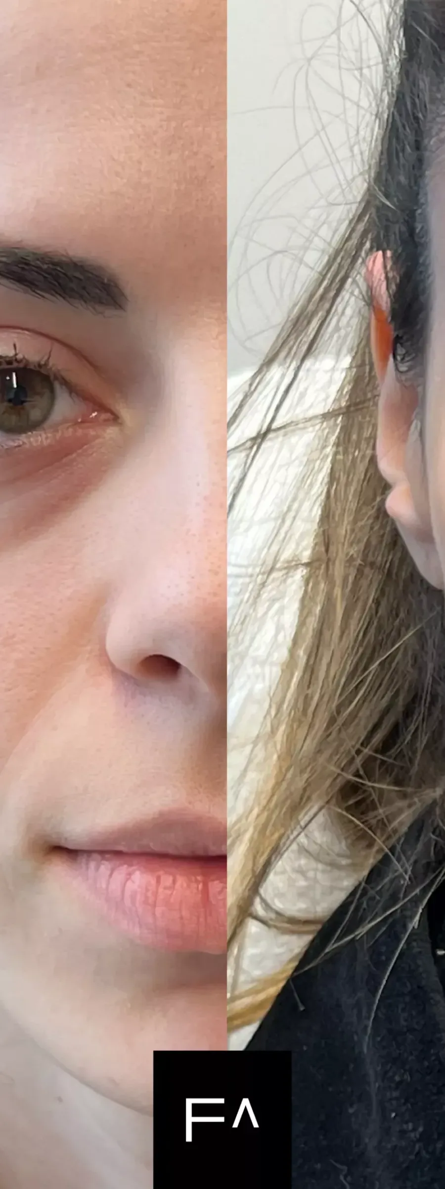 Before and after: Hyaluronic Acid for under-eye bags (dark circles), left before, right after.