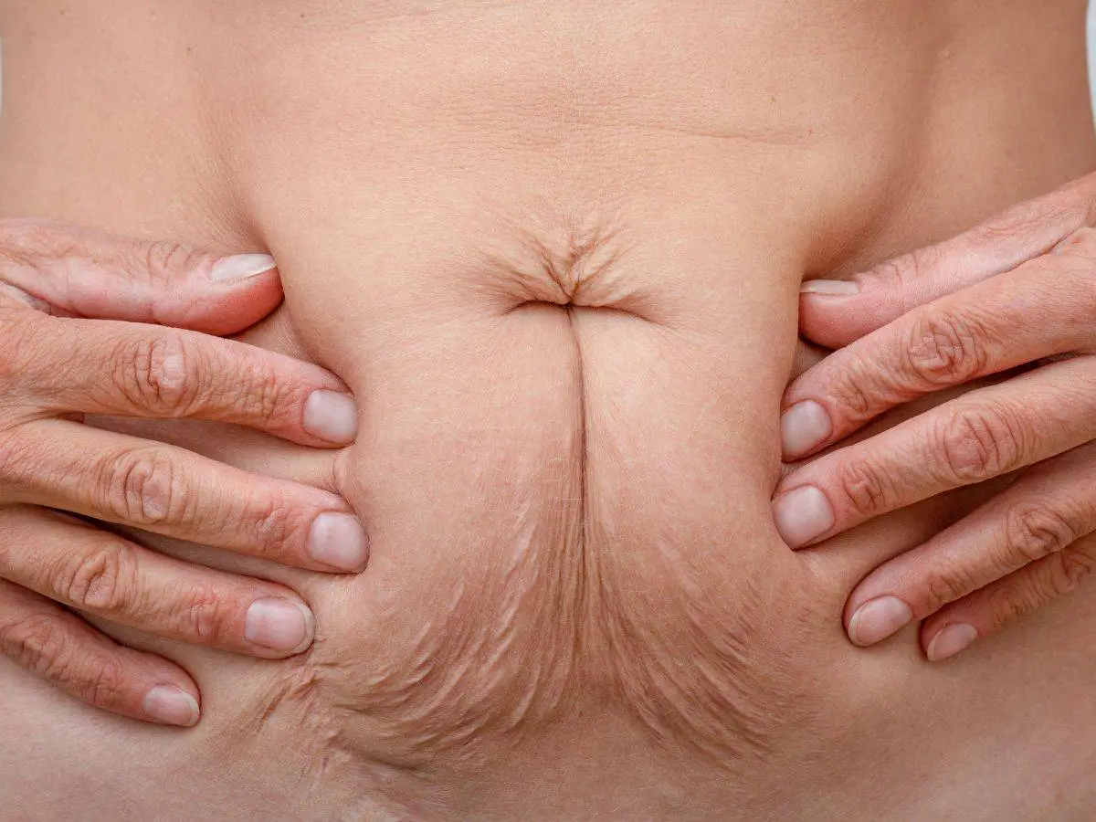 Skin Laxity After Liposuction: Why It Happens & Solutions