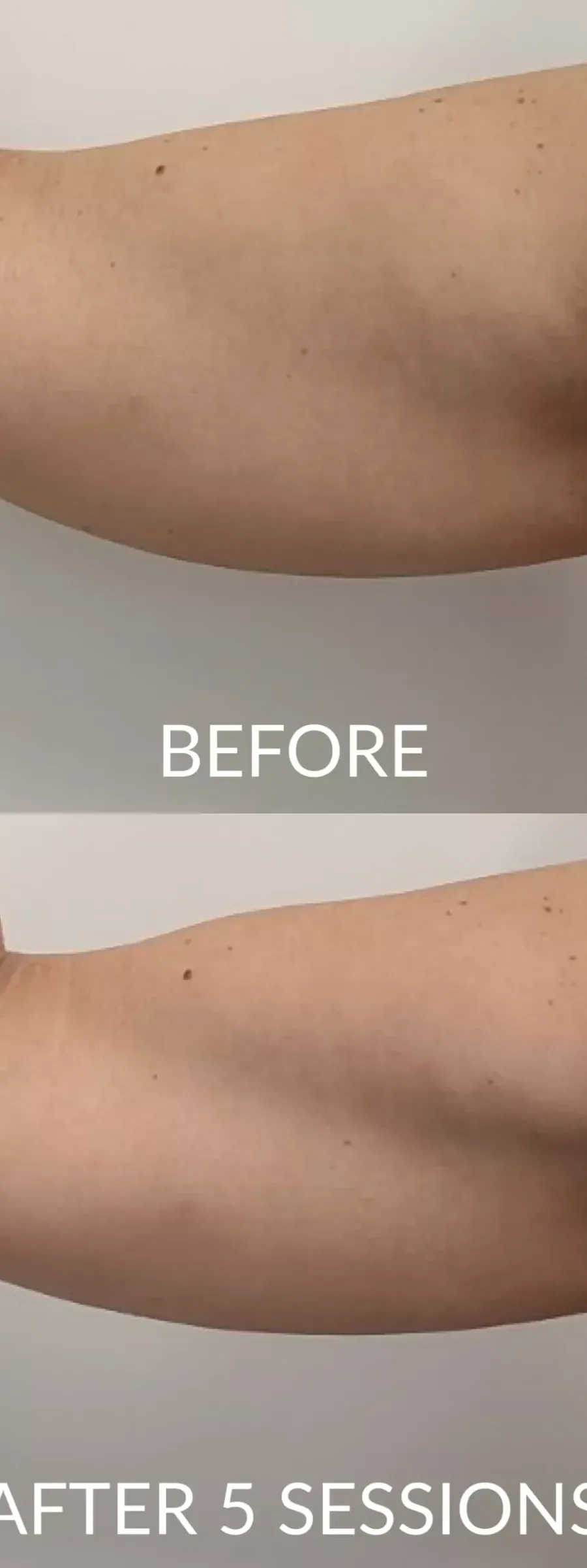 Exilis στα μπράτσα
