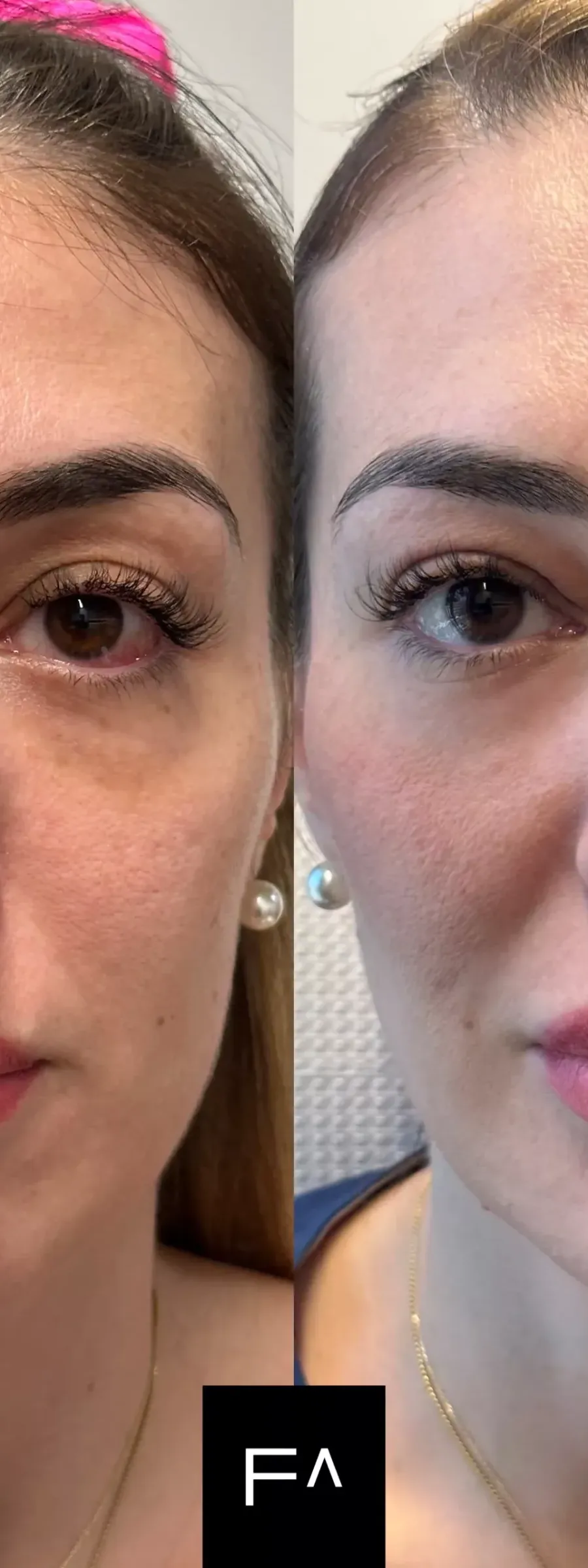 Hyaluronic Acid – Results of Hyaluronic Acid in a woman before and after treatment.