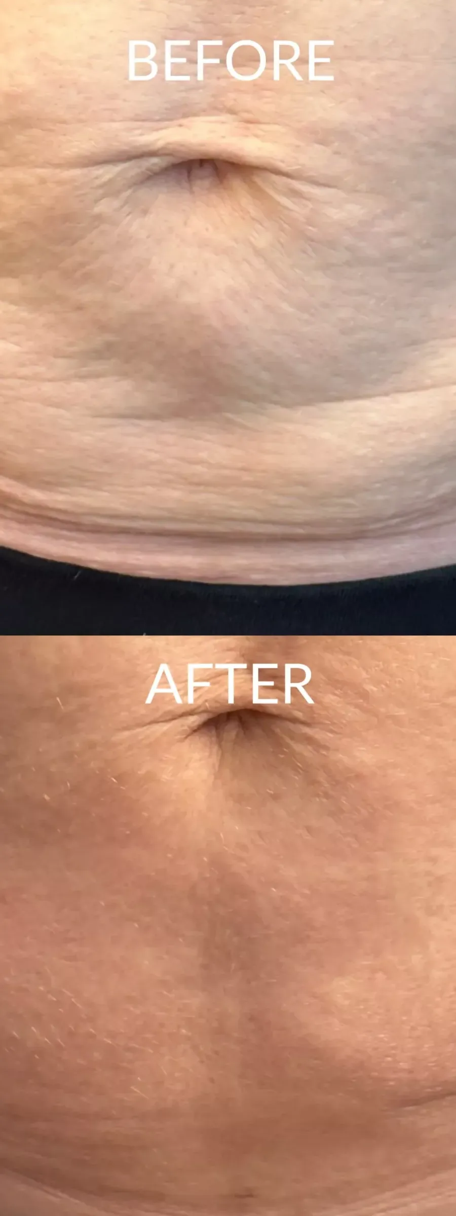 Exilis στην κοιλιά
