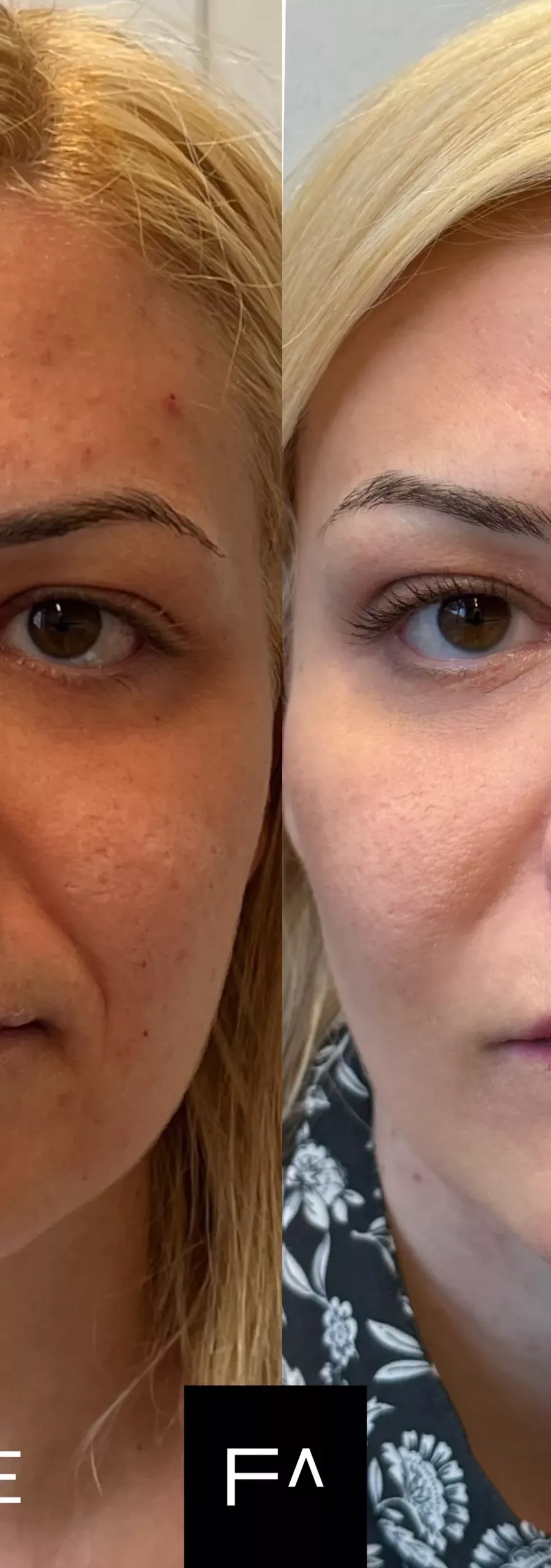 Before and after: Woman with improved facial appearance from Hyaluronic Acid treatment.