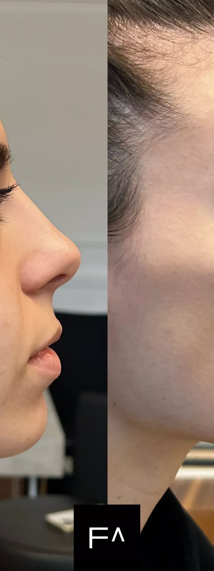Woman before and after aesthetic intervention with Hyaluronic Acid, in profile.