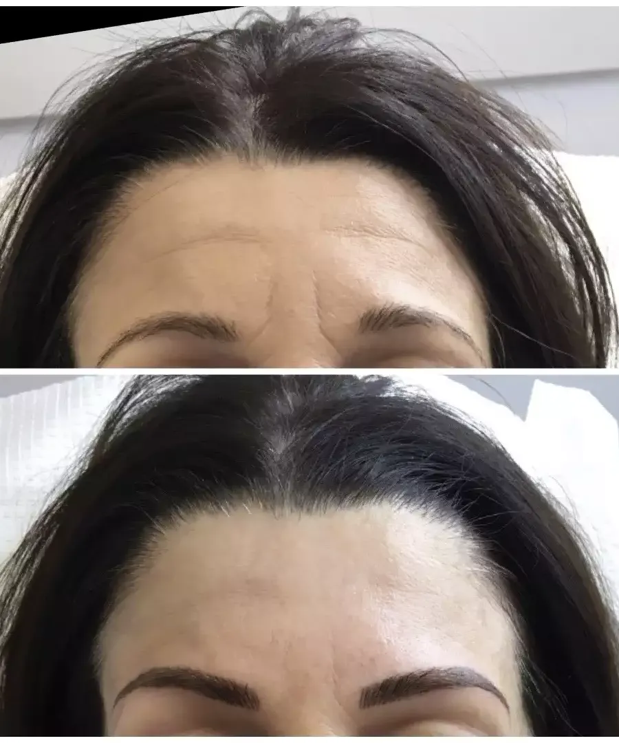 Αποτελέσματα microblading στην περιοχή των φρυδιών πριν και μετά.
