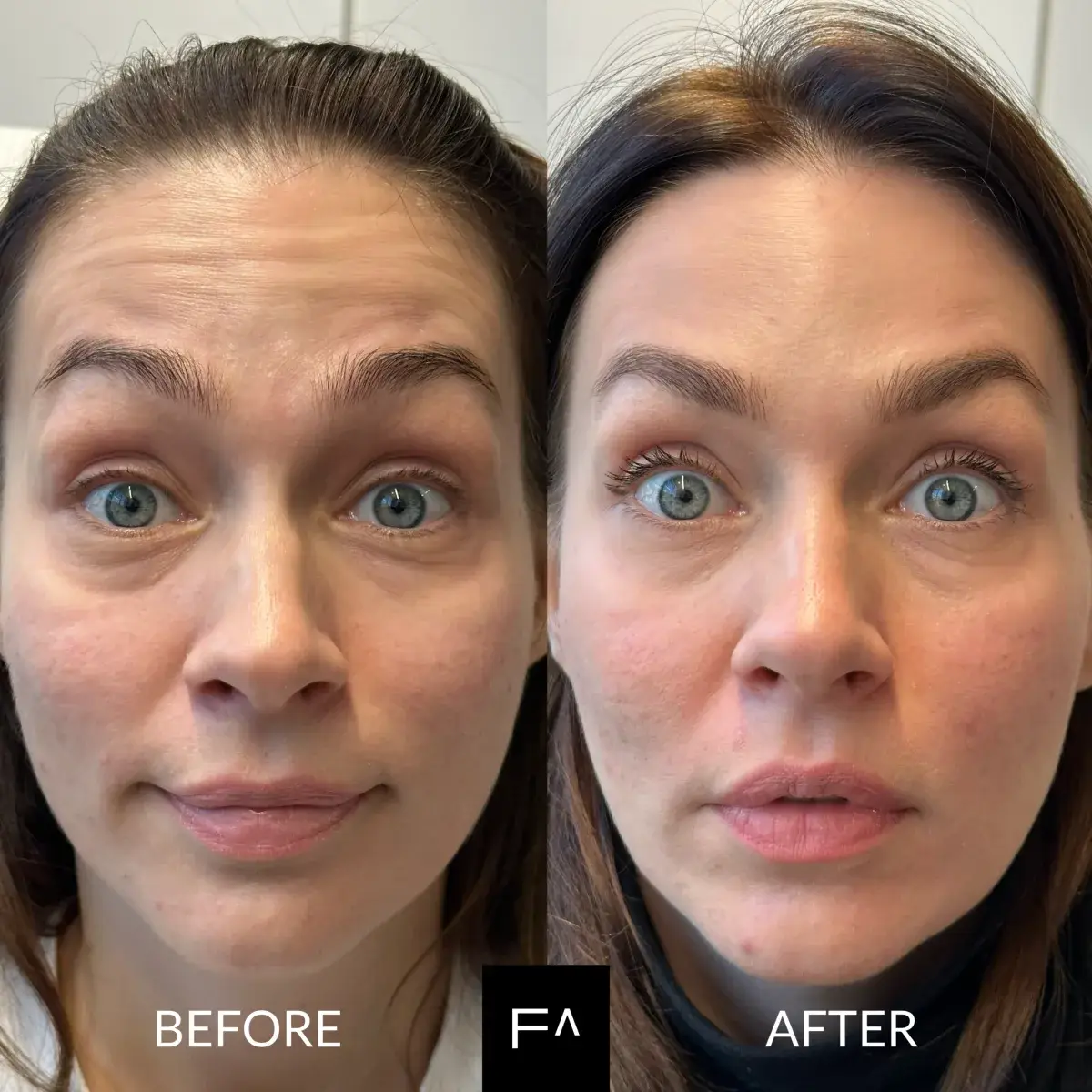 πριν και μετά: Τι Απαγορεύεται μετά το Botox: 6 Οδηγίες & Χρονοδιάγραμμα στο μέτωπο και τα μάτια