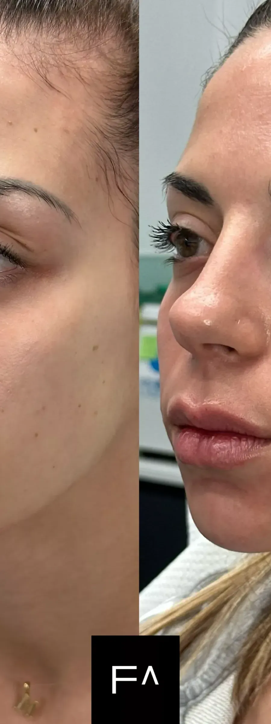 before and after Beautification: What it is, Procedure & Facial Results