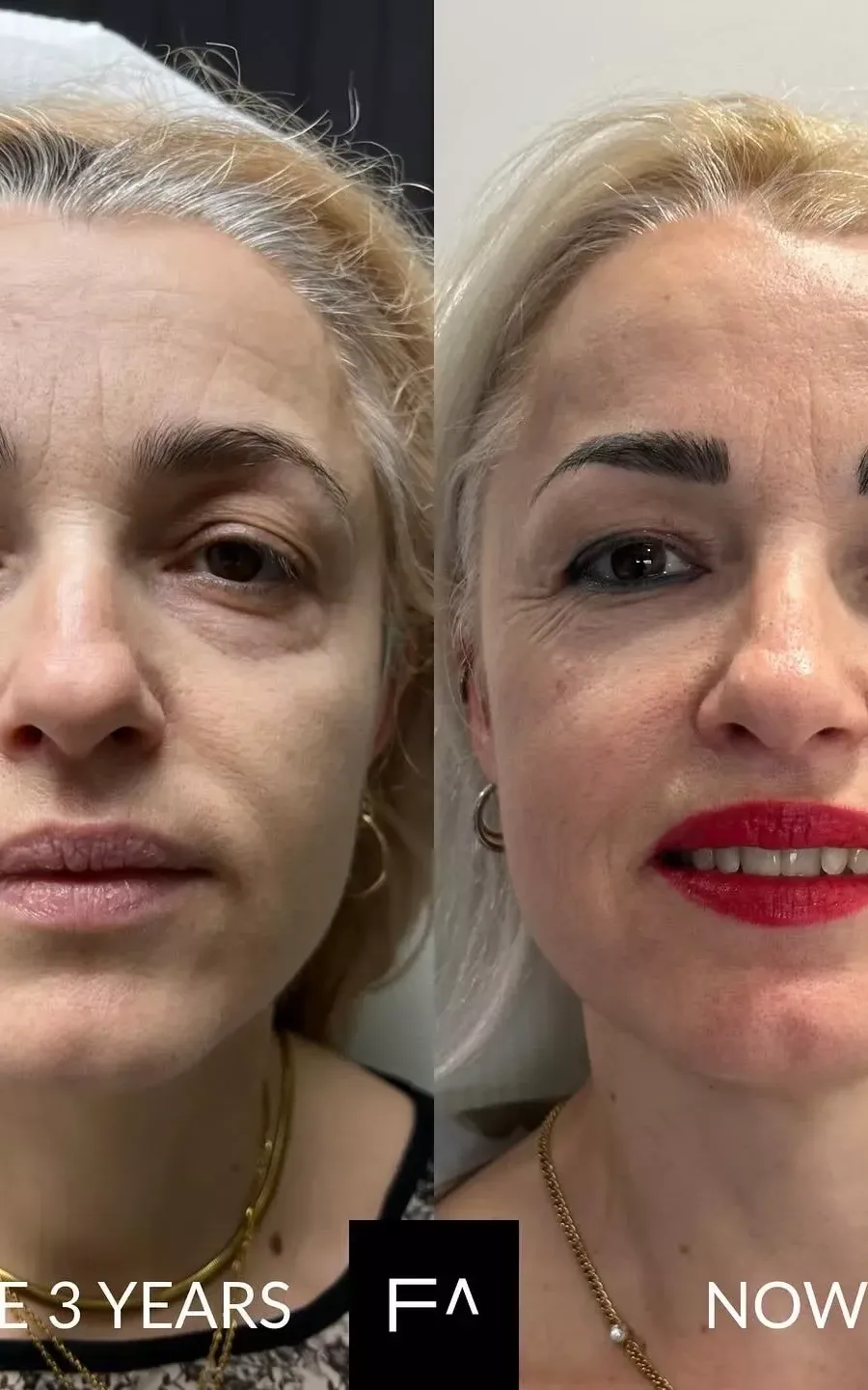before and after Beautification: What it is, Procedure & Facial Results on a woman