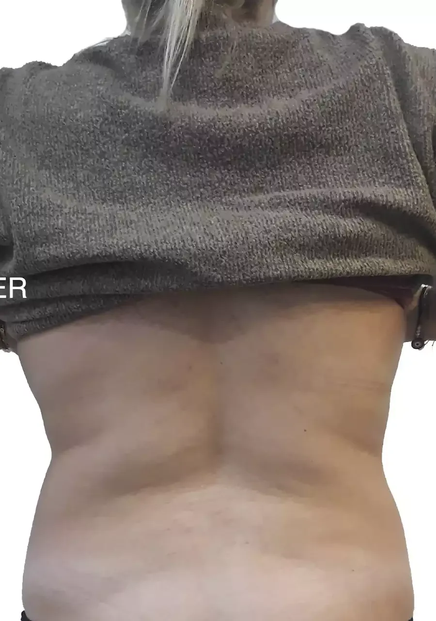 Microlipo: Η mini λιποαναρρόφηση στην πλάτη μετά την αφαίρεση λίπους