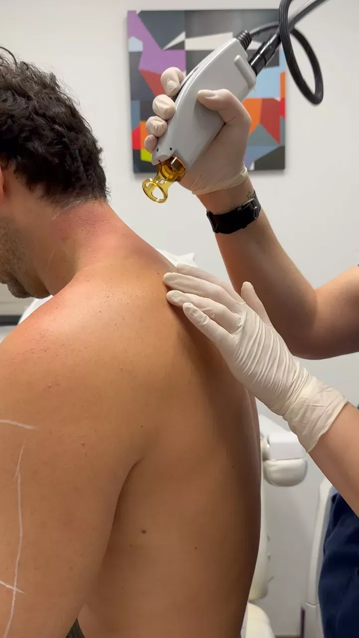 Laser Hair Removal for Back: For a Clean Back Without Pain
