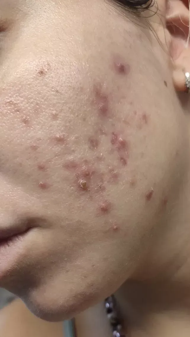 Acne Treatment: Θεραπεία αντιμετώπισης για τη Ροδόχρους Ακμή στο πηγούνι και το μάγουλο