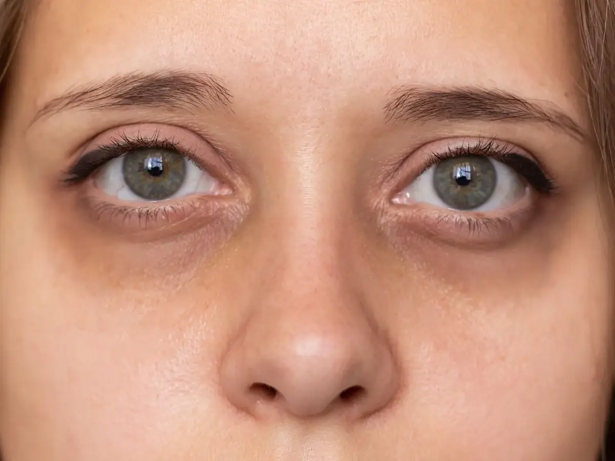 Dark Circles