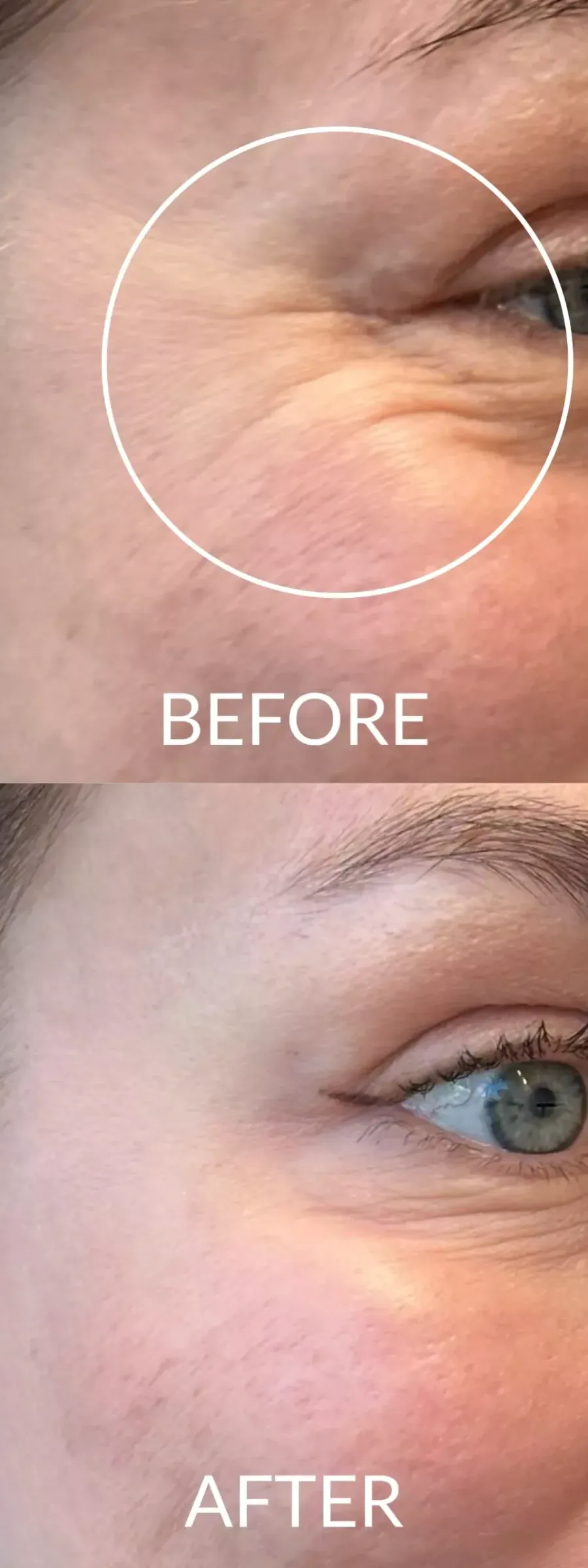 Αποτελέσματα Botox: πριν και μετά θεραπεία ρυτίδων ματιών σε γυναίκα.