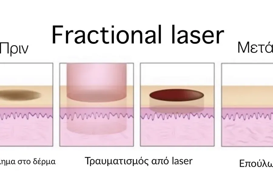 Fractional Laser: What it is, Cost, Before and After