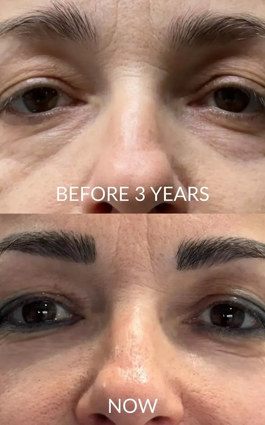 before and after Beautification: What it is, Procedure & Facial Results in the eyes