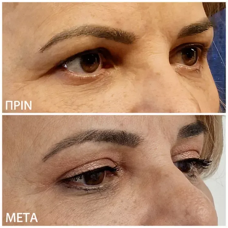 πριν και μετά Βλεφαροπλαστική στα μάτια γυναίκας
