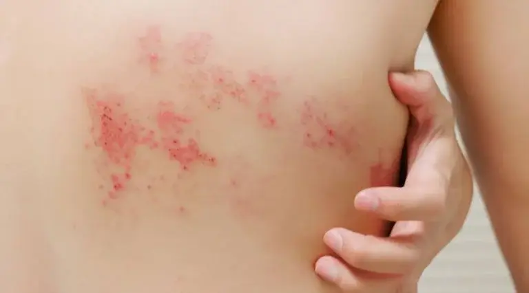 Shingles (herpes zoster) — red blistering rash on the torso