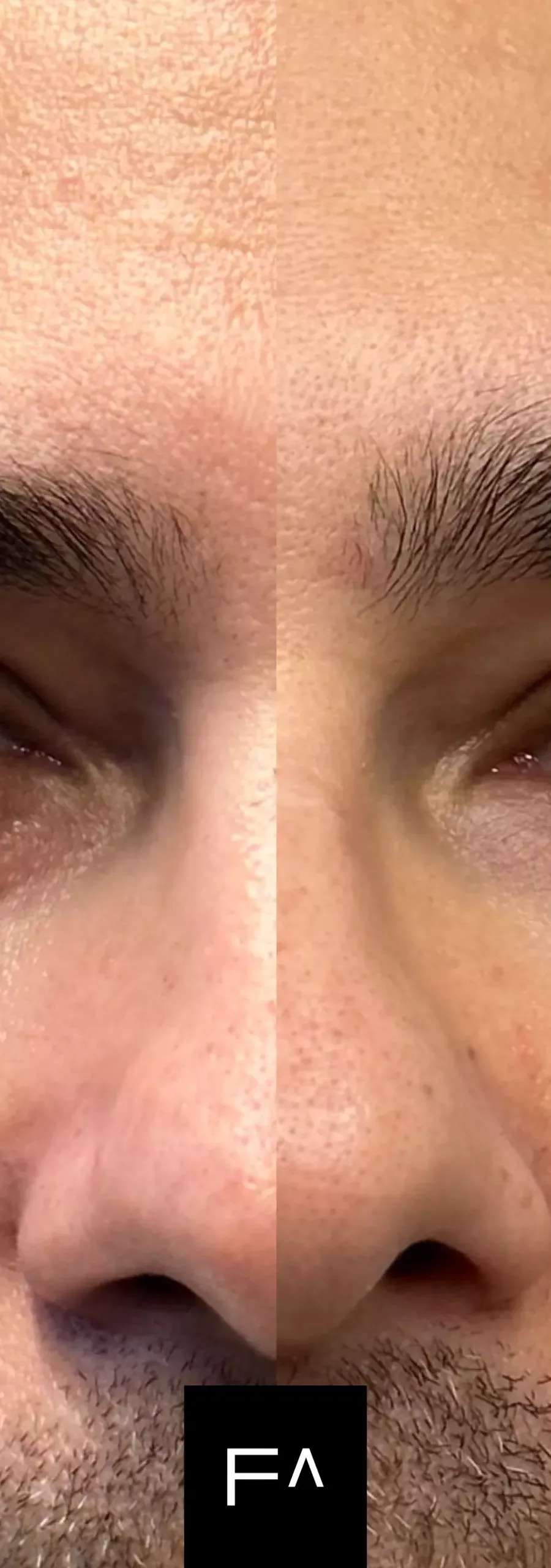 Facial appearance before and after using Hyaluronic Acid in the eye area.