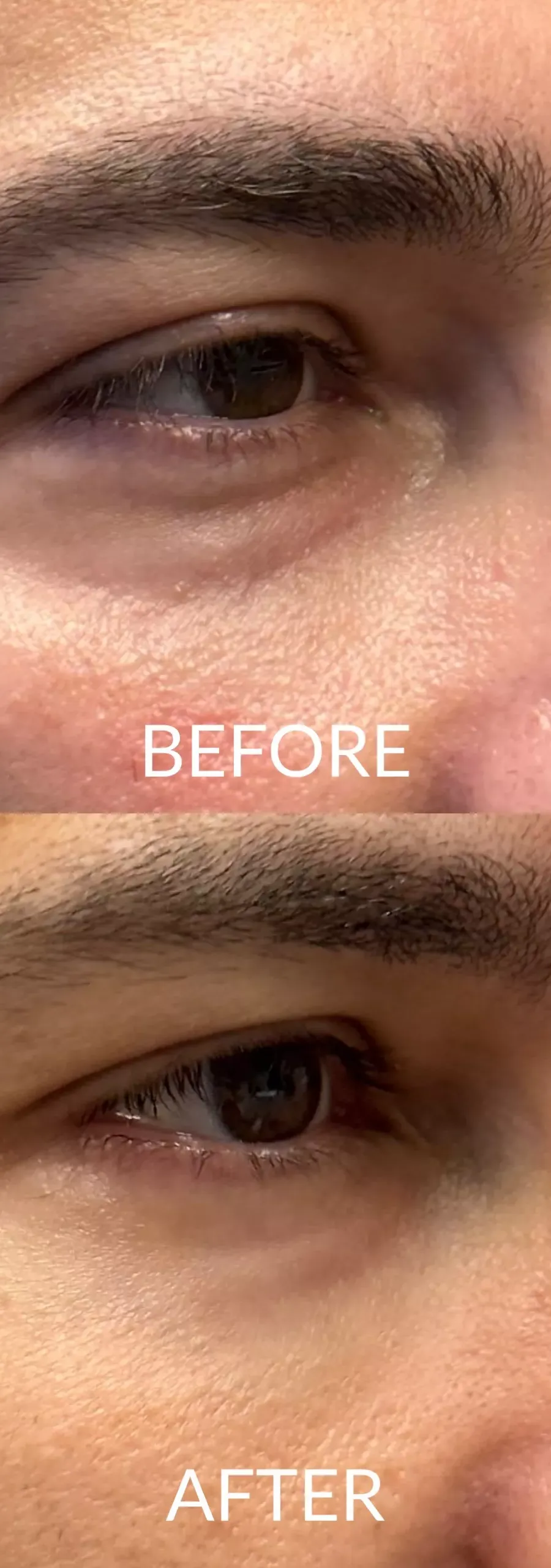 Before and after: Hyaluronic Acid for improvement of dark circles and under-eye bags.