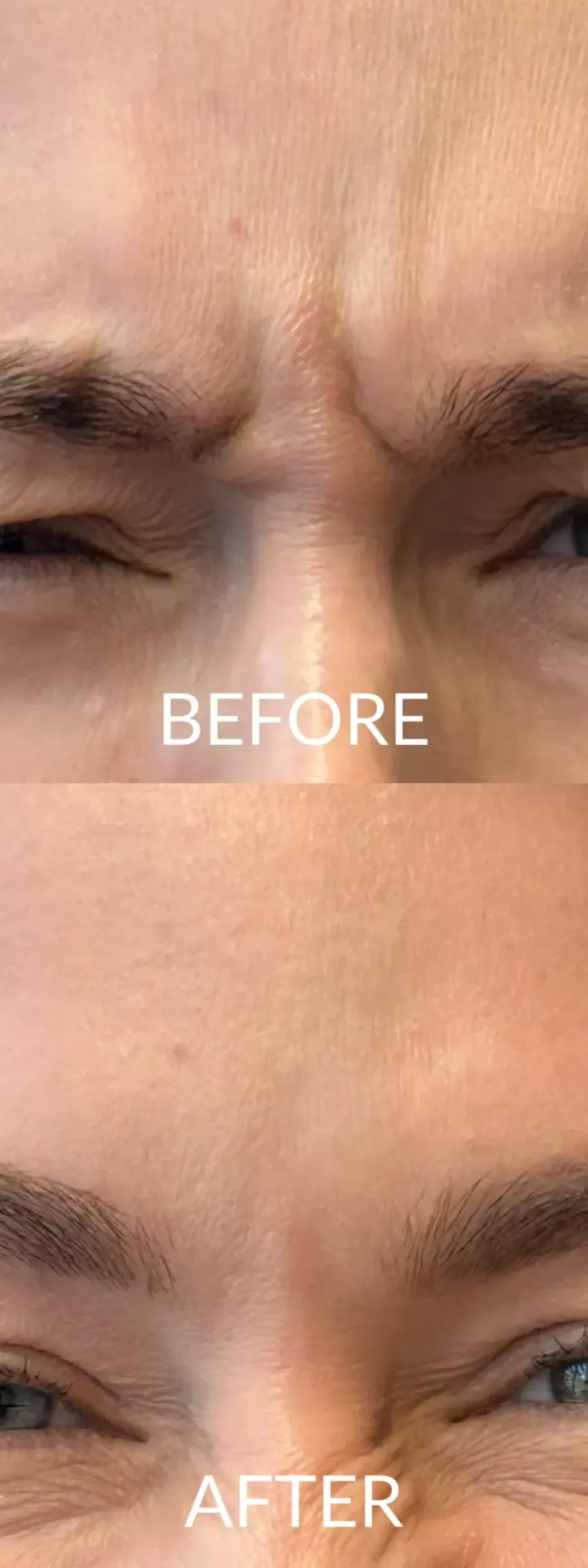 Αποτελέσματα Botox: Πριν και μετά τη θεραπεία σε γυναίκα που συνοφρυώνεται.