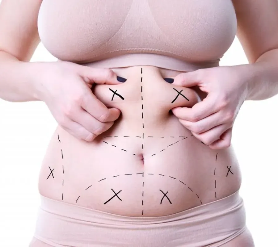 Body with surgical markings for fat removal, unrelated to Treatments for Double Chin.