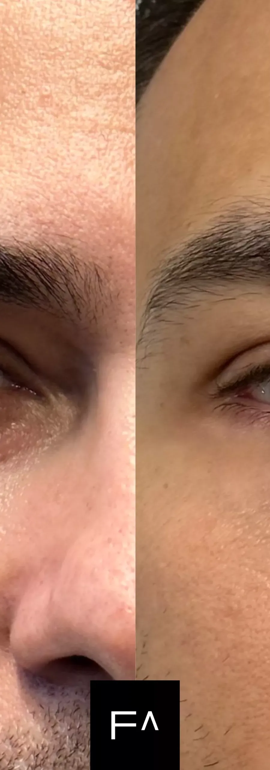 Before and after: Hyaluronic Acid in the under-eye area to treat dark circles.