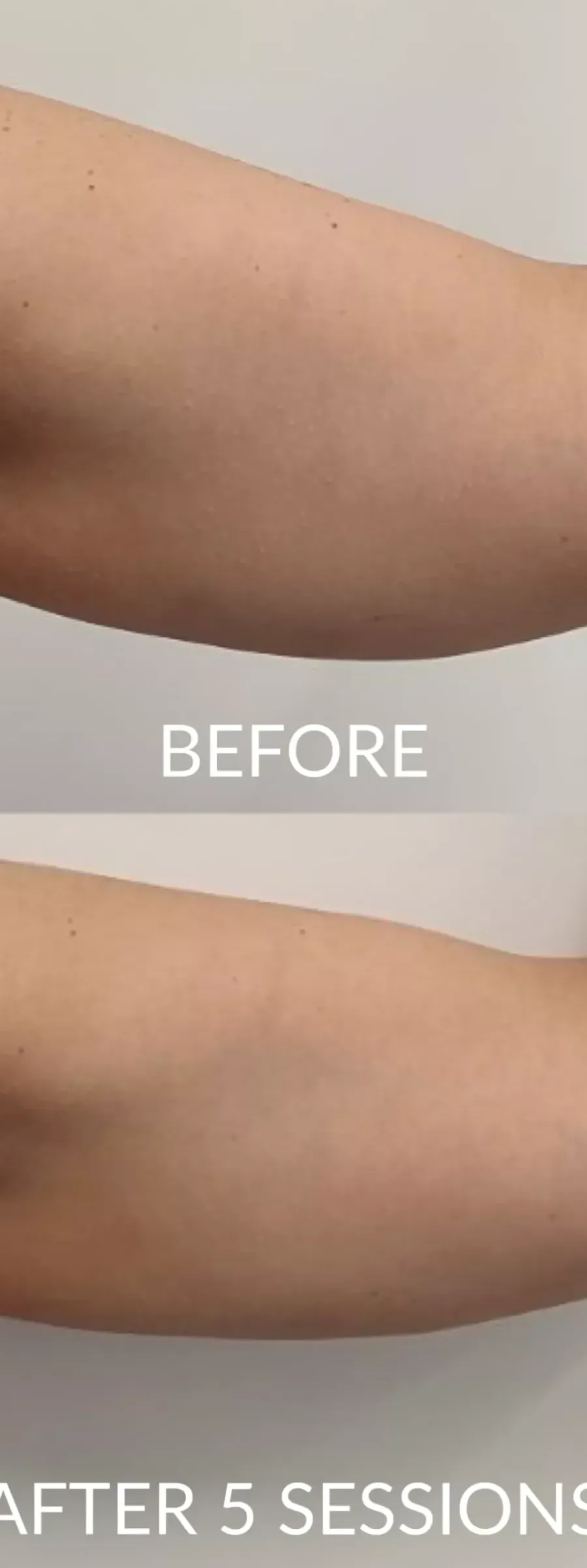 Exilis στα χέρια