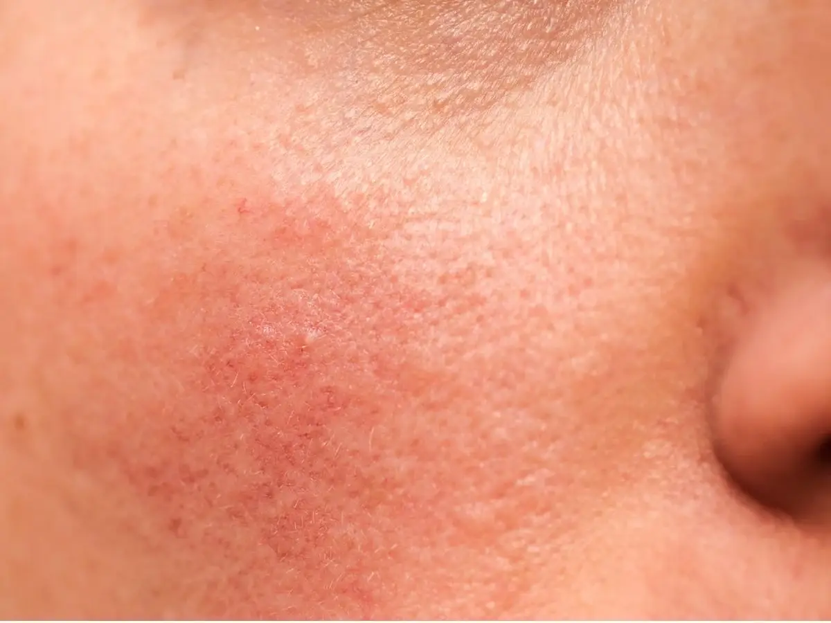 Dry Skin