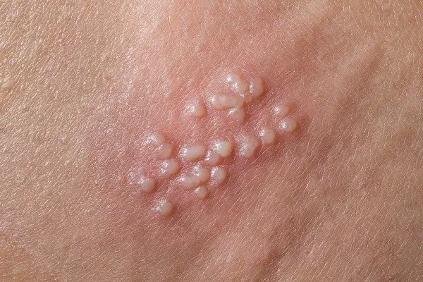 Close-up of skin with small blisters, a symptom of Genital Herpes: Symptoms, Transmission & Treatment.