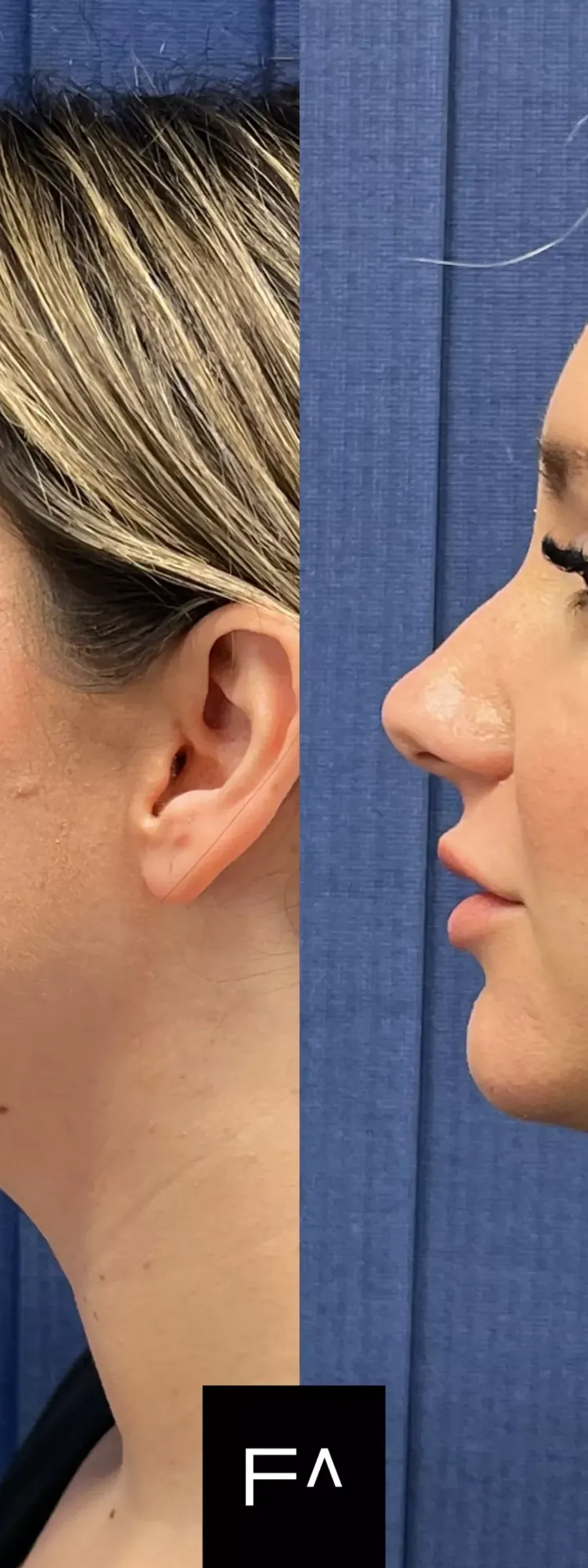 Hyaluronic Acid: Before and after chin and lip augmentation in a woman, side view.