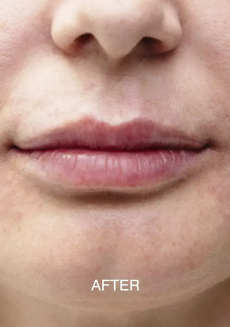 Lips — after