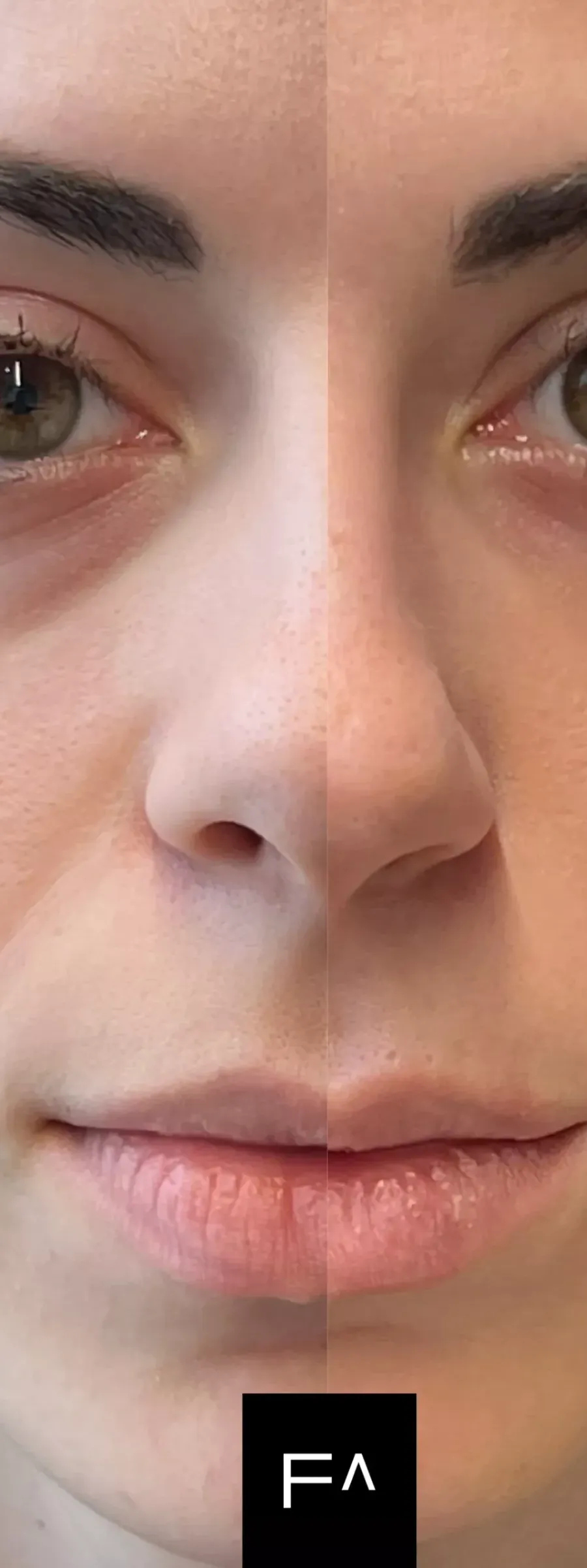 Hyaluronic Acid – Before and after application of Hyaluronic Acid in the under-eye area.