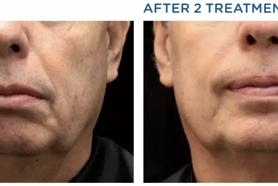 πριν και μετά Notox Exilis στο κάτω μέρος του προσώπου και το πηγούνι
