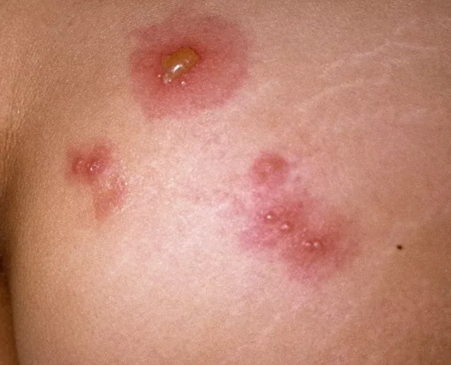 Red inflamed skin with fluid-filled blisters showing Genital Herpes: Symptoms, Transmission & Treatment.