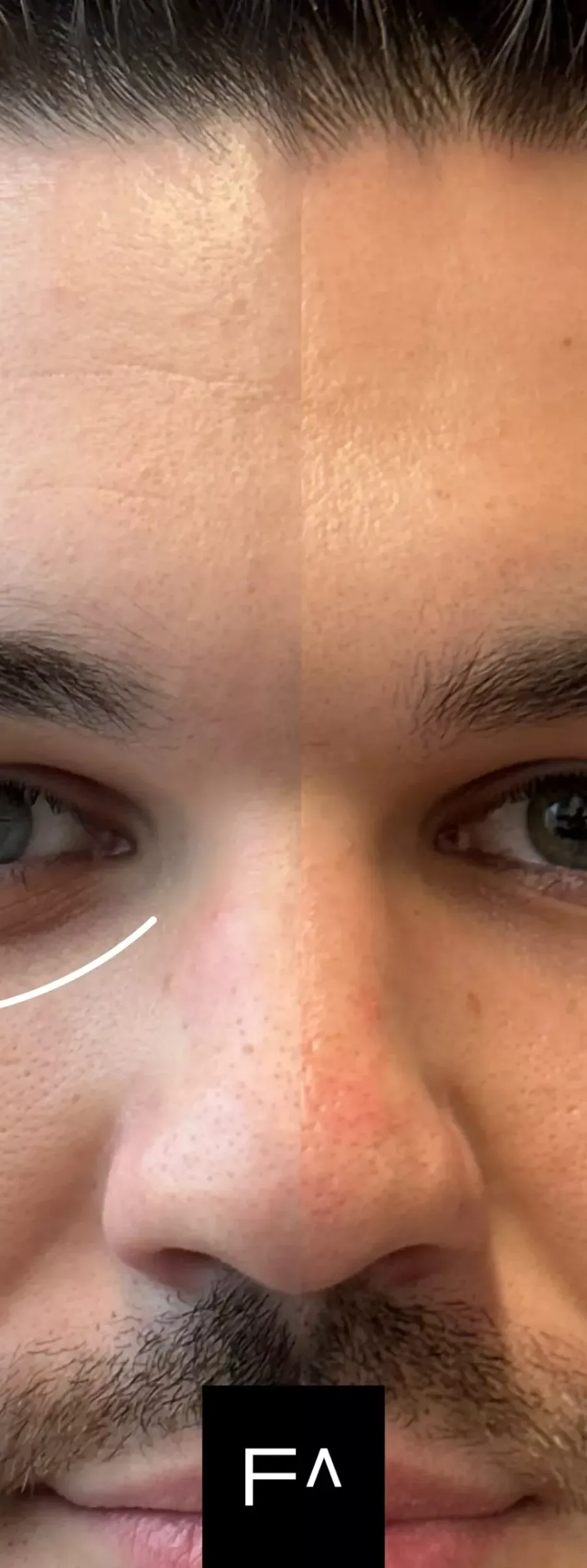 Botox: Αποτελέσματα πριν και μετά σε άνδρα, με λείανση ρυτίδων στο μέτωπο και γύρω από τα μάτια.
