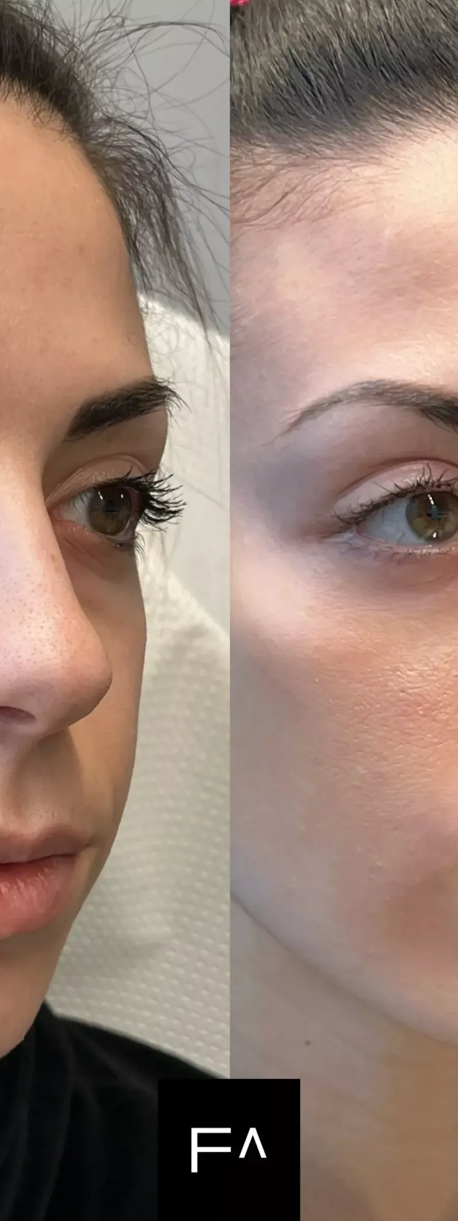 Before and after: A woman with Hyaluronic Acid in the cheekbones and under-eye area.