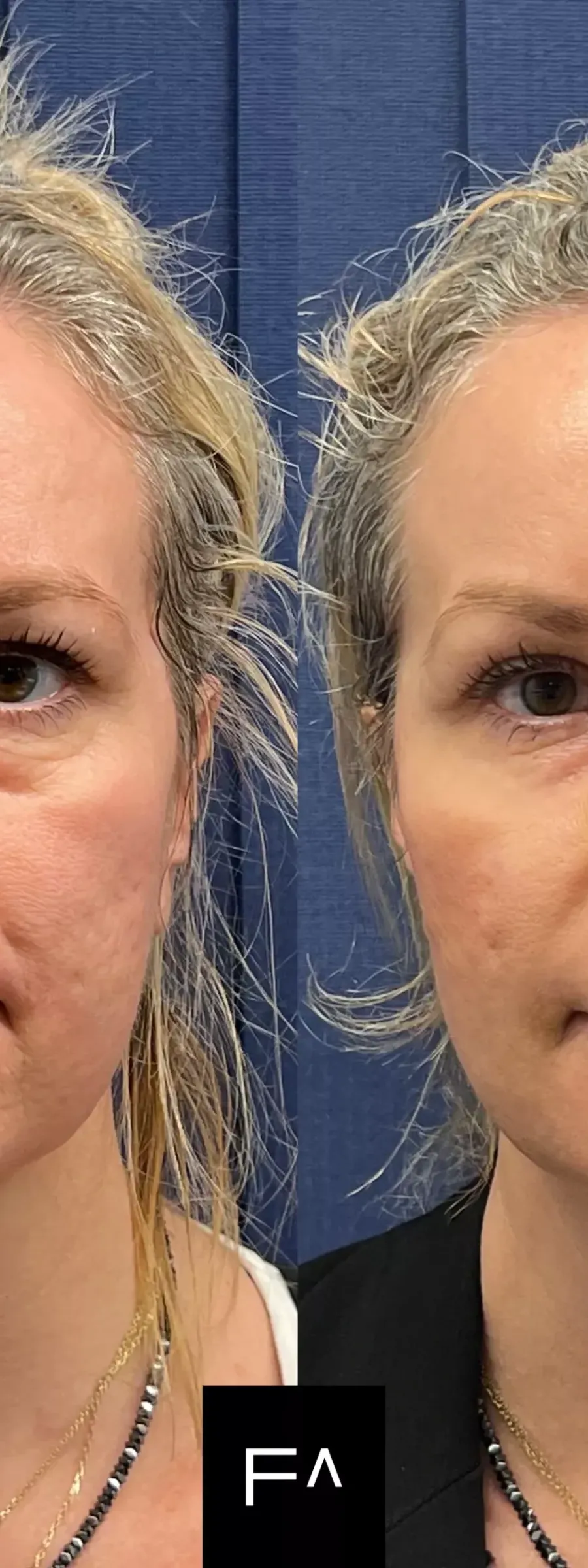 before and after Beautification: What it is, Procedure & Facial Results on the face