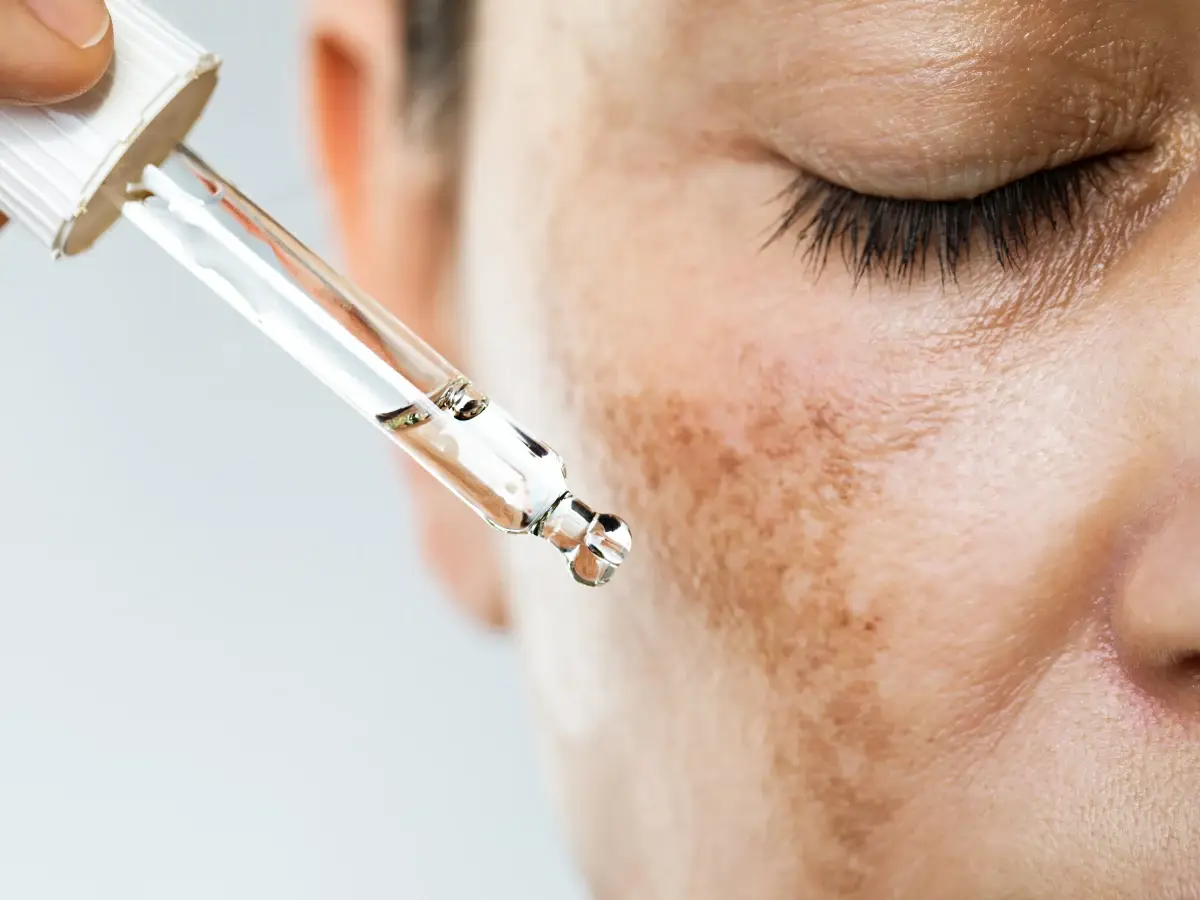 Facial Hyperpigmentation