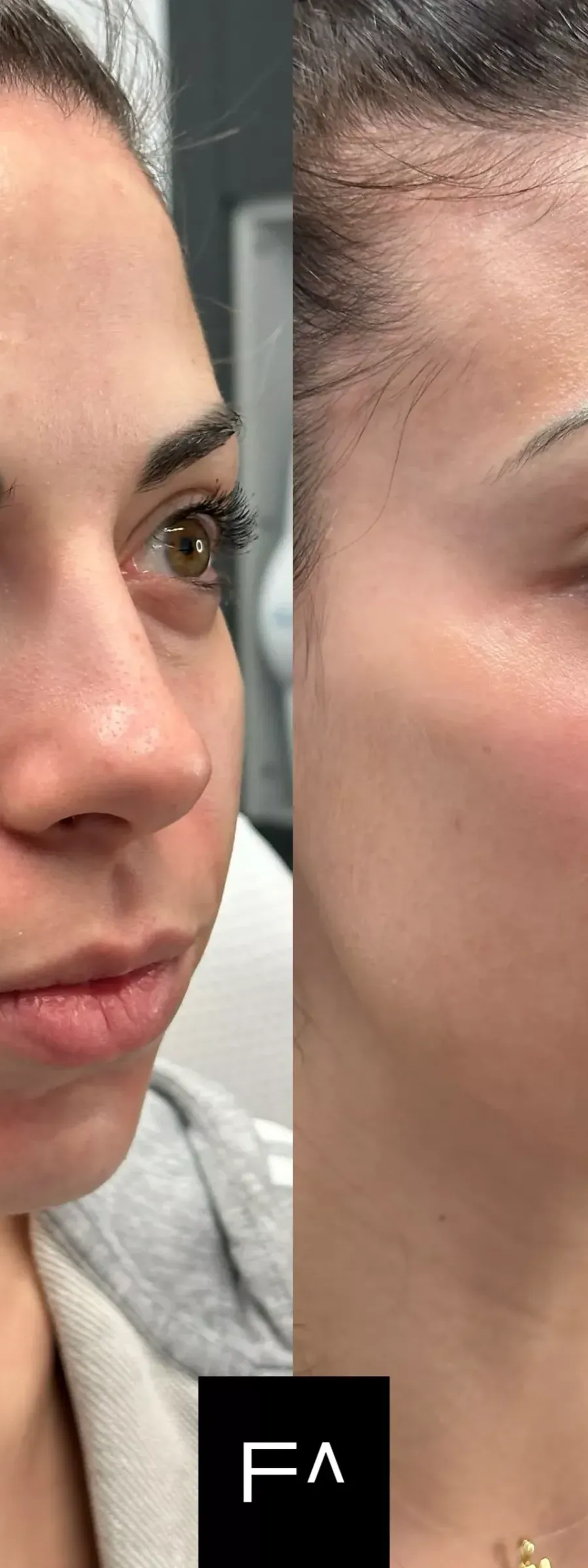 before and after Beautification: What it is, Procedure & Facial Results in the side profile
